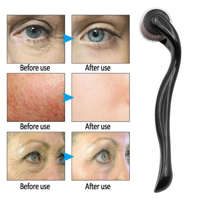 540 Derma Roller – Hair Growth, Beard & Skin Care Micro-Needle Treatment